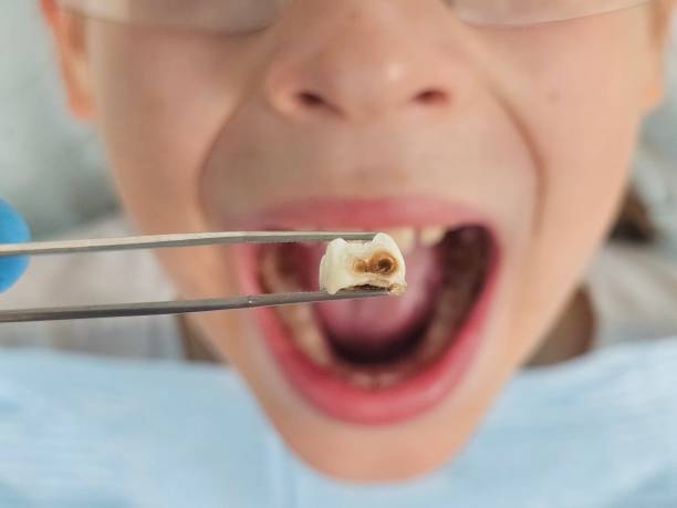 Best Emergency Dentist for Lost Fillings or Crowns in Talent, OR
